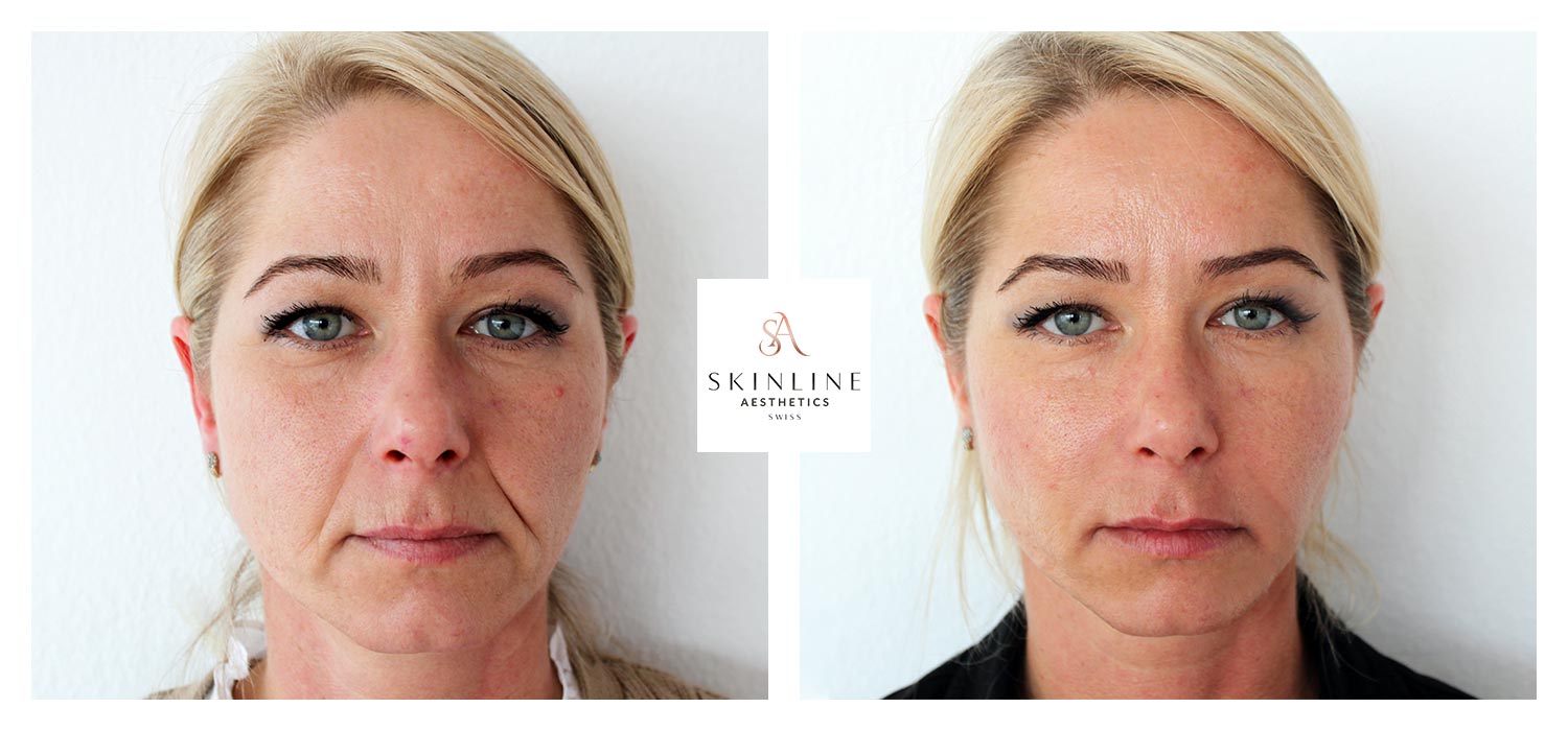 Vorher / NachherGalerie Skinline Aesthetics Swiss